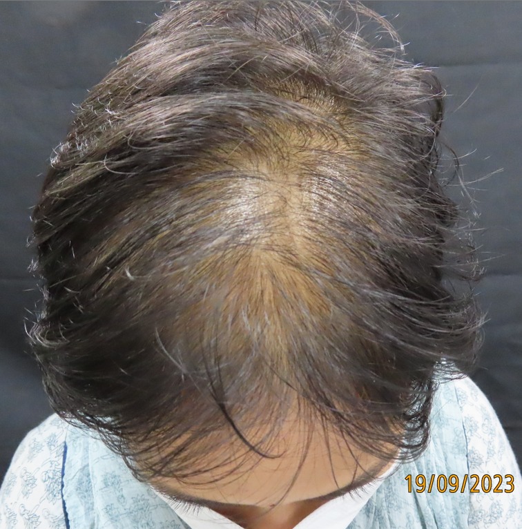 Hair Loss Treatment before treatment