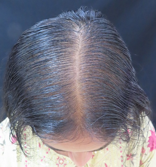 Hair Loss Treatment after treatment