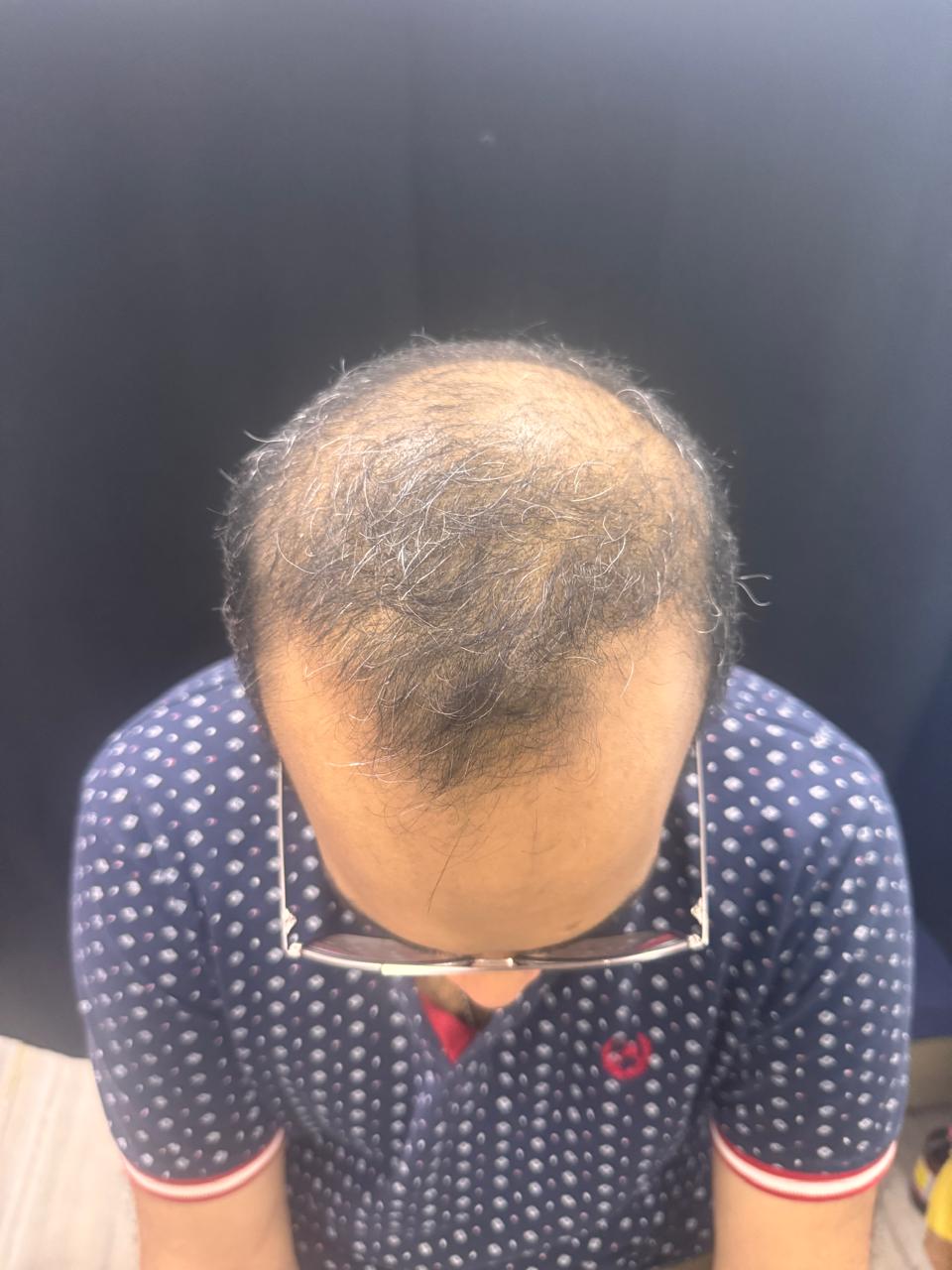 Hair Transplant before treatment