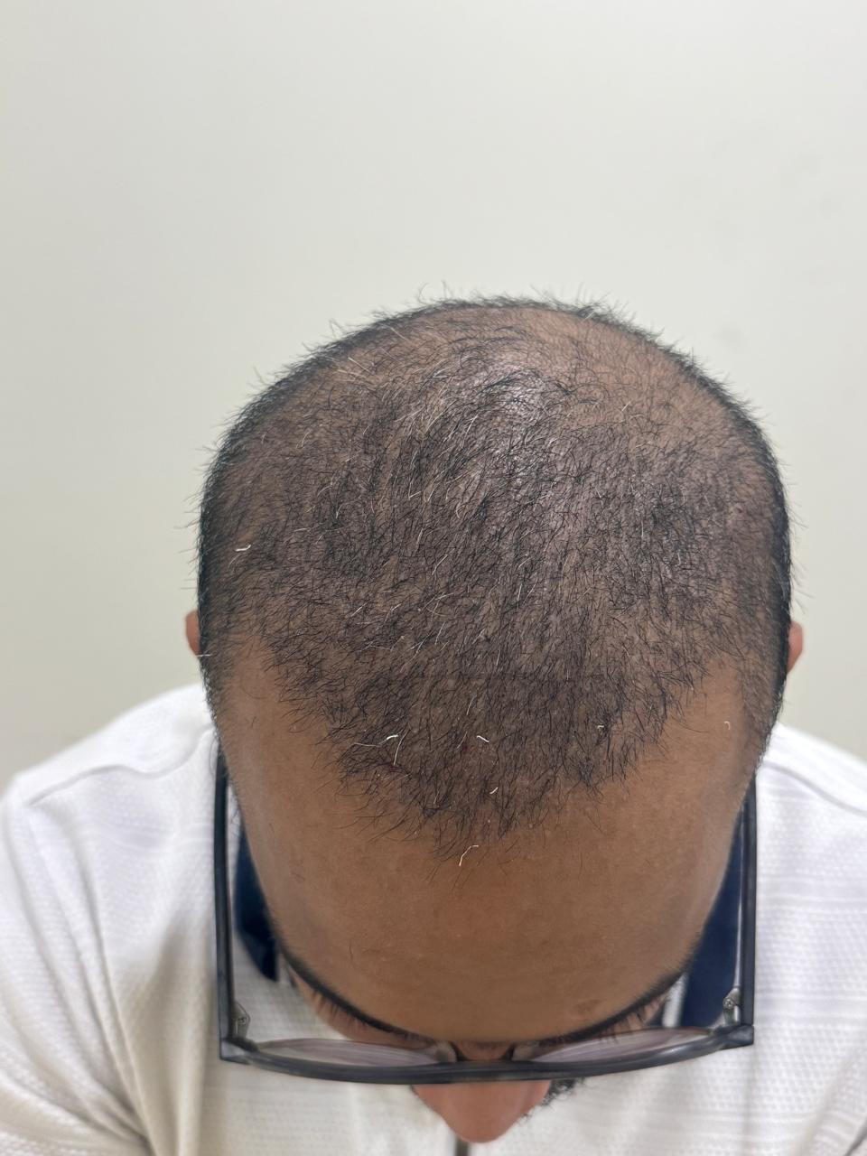 Hair Transplant after treatment